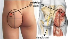 Kalça Kemiği Ağrısı Belirtileri ve Tedavisi Kalça Kemiği Ağrısı Belirtileri ve Tedavisi