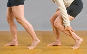 Bacak Ağrısı Nedenleri Belirtileri ve Tedavisi Bacak Ağrısı Nedenleri Belirtileri ve Tedavisi