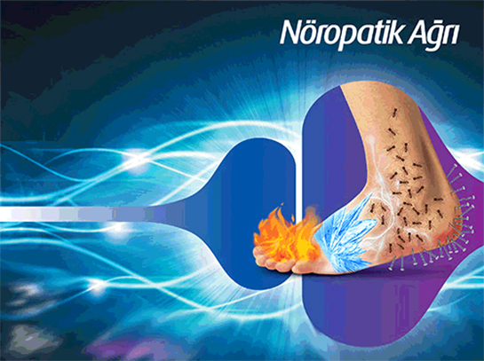 Nöropatik Ağrı Belirtileri ve Tedavisi